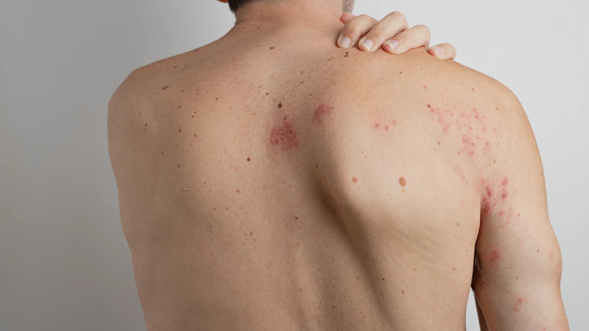 understanding shingles